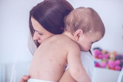 Chickenpox In Motherhood: A Dermatologist’s Perspective