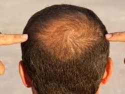 20 से 30 की उम्र में झड़ते बाल कहीं कर दे न आपको गंजा! इन घरेलू नुस्खों से बालों की बढ़ाएं मजबूती