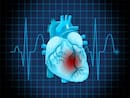 Heart Failure: Is Reversal Of Cardiac Amyloidosis Possible?