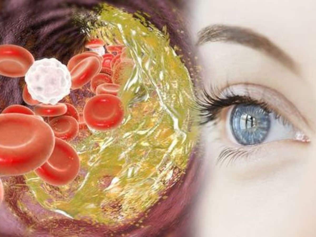 Cholesterol Deposit Around The Eyes | White Line On Iris Or Outer Eye Is  Called Arcus Senilis, How Harmful Is It, Know The Causes, Symptoms, And  Treatment | Aankho Ki Putli Ke