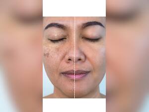 Melasma: Treatment And Medications For This Skin Problem
