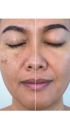 Melasma: Treatment And Medications For This Skin Problem