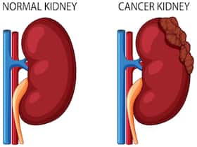 Metastatic Kidney Cancer: Prognostic Factors and Novel Treatment Approaches