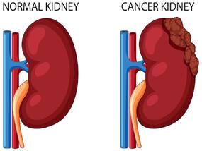 Metastatic Kidney Cancer: Prognostic Factors and Novel Treatment Approaches