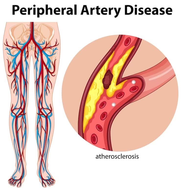 Diabetes Complications: Peripheral Arterial Disease Can Lead To Critical Limb Ischemia