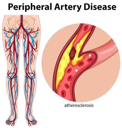 Vascular Surgery in Diabetes Management: Not Just It Prevents Limb Loss But Improves Overall Quality Of Life