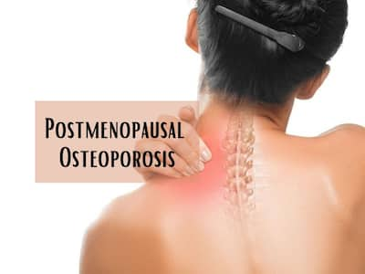 Postmenopausal Osteoporosis: 10 Unusual Causes of Bone Loss Women Shouldn't Ignore