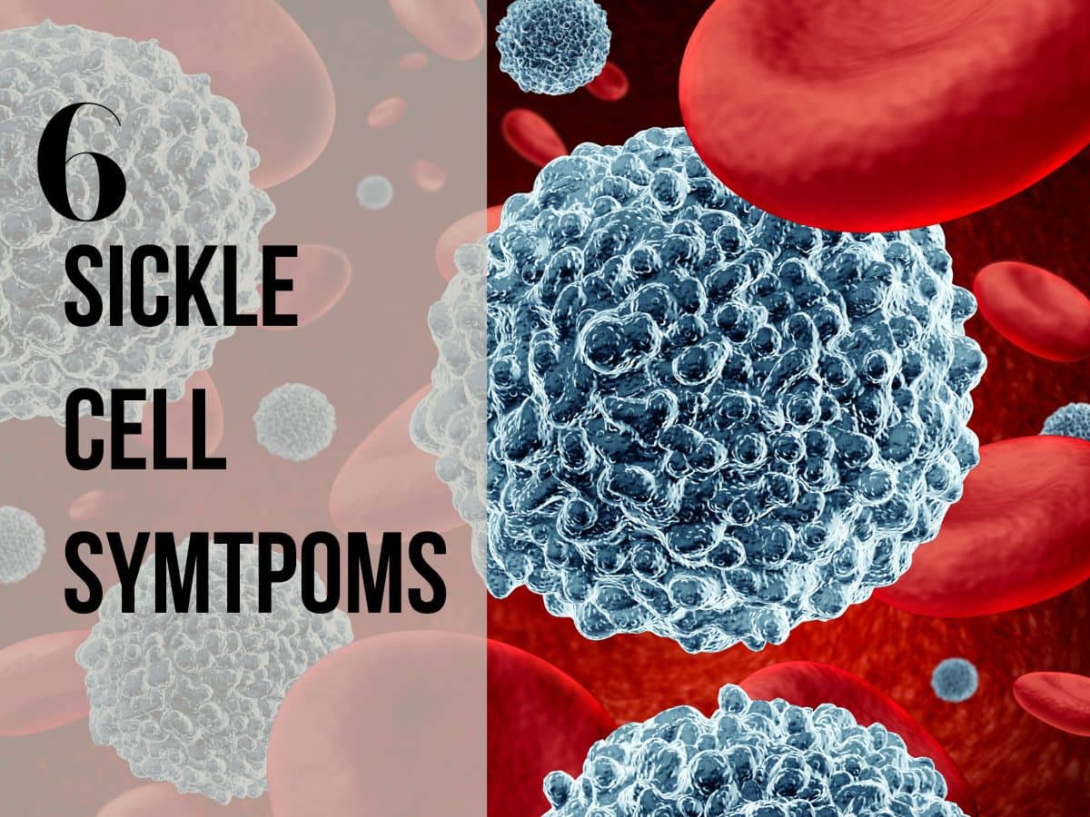 sickle cell symptoms
