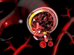 Sickle Cell Disease Pain Management: Treatment Options and Quality of Life Improvement