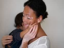 Vitiligo Effects Go Beyond The Skin:    While Growing Up I Was Called A Ghost