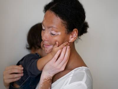 Vitiligo Effects Go Beyond The Skin: ‘While Growing Up I Was Called A Ghost’