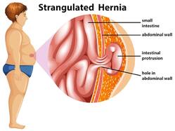 Current Trends In Hernia Treatment: Advances And New Technologies