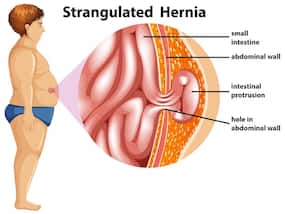 Current Trends In Hernia Treatment: Advances And New Technologies