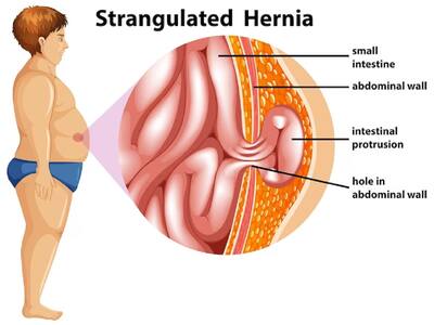 Current Trends In Hernia Treatment: Advances And New Technologies