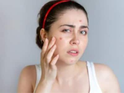 Suffering From Breakouts? Expert Issues Warning On Warning On Acne-Inducing Supplements