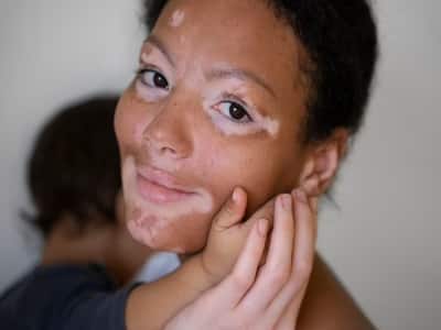 What Are The Treatment Options For Vitiligo?