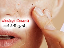 फेस-नाक पर ब्लैकहैड्स से परेशान? इन 4 आसान तरीकों से निकालें जिद्दी से जिद्दी ब्लैकहैड्स और पाएं साफ-बेदाग स्किन