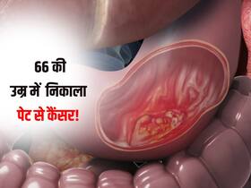 पेट और फूड पाइप के बीच कैंसर निकालने के लिए डॉक्टरों ने किया ये काम, जानें 66 साल के मरीज के सफल इलाज की कहानी