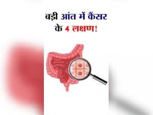 पुरुषों में 'बड़ी' आंत के कैंसर के 4 लक्षण