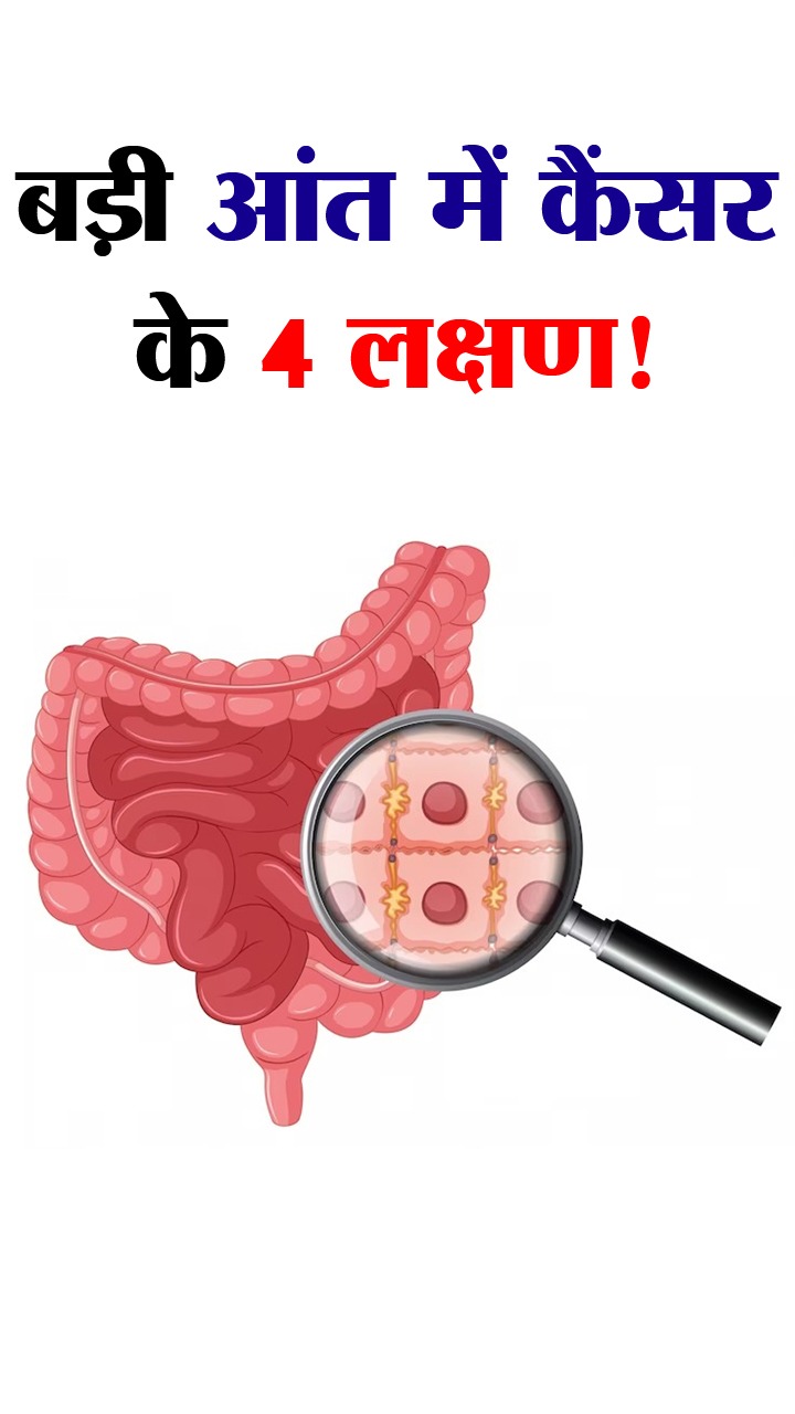 पुरुषों में 'बड़ी' आंत के कैंसर के 4 लक्षण
