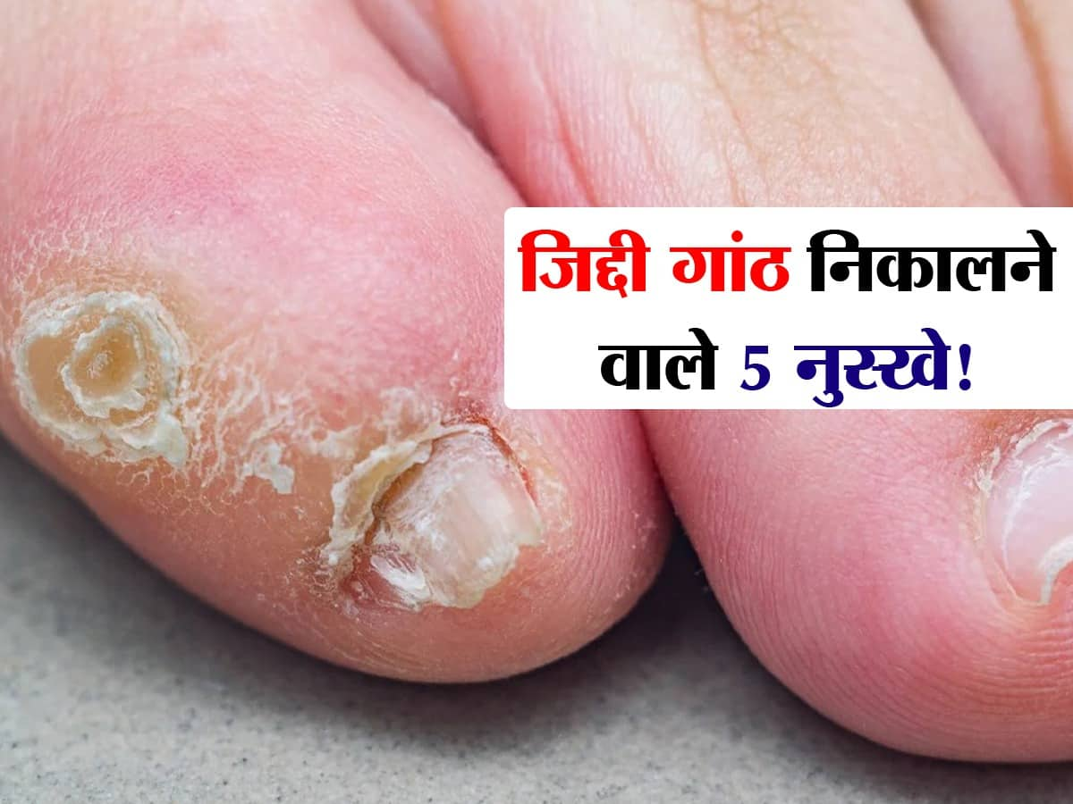 Corn in foot in 2024 hindi