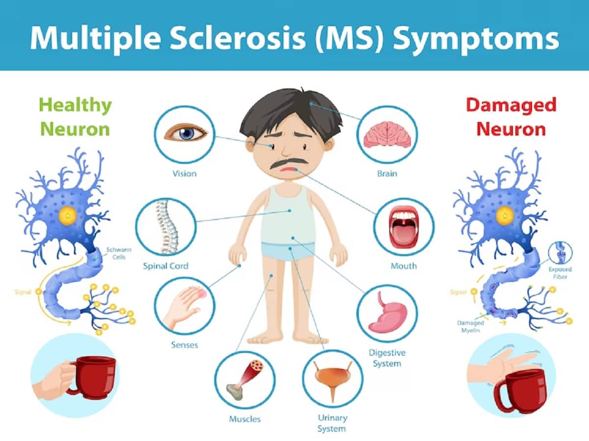 early signs of multiple sclerosis
