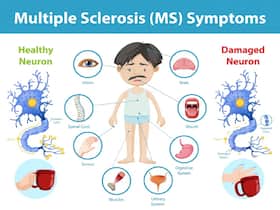 Multiple Sclerosis: Double Vision And Other Warning Signs In The Eyes Multiple Sclerosis: Double Vision And Other Warning Signs In The Eyes
