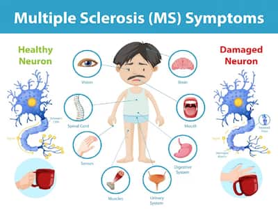 Multiple Sclerosis: Double Vision And Other Warning Signs In The Eyes