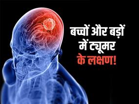 रोज सिरदर्द के लिए खा रहे गोलियां? बार-बार सिरदर्द ब्रेन ट्यूमर का लक्षण, जानें बच्चों से लेकर बड़ों में दिखने वाले लक्षण