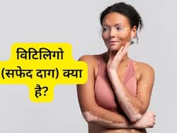 सफेद दाग को भी ठीक करने का ताकत रखती है ये 1 जड़ी-बूटी, जानिए विटिलिगो क्या है और आयुर्वेदिक उपचार