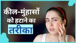 Skin Acne Tips: कील-मुंहासों को हटाने के लिए इन 3 चीजों का करें इस्तेमाल