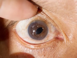 What Are The Advantages Of Phacoemulsification Cataract Surgery?