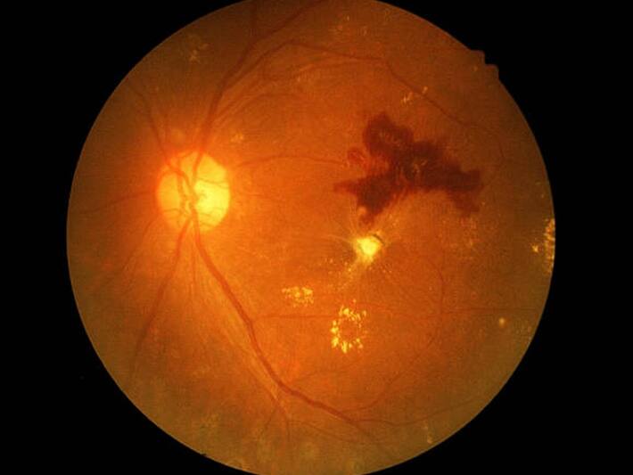 5 Diseases That Can Cause Blindness