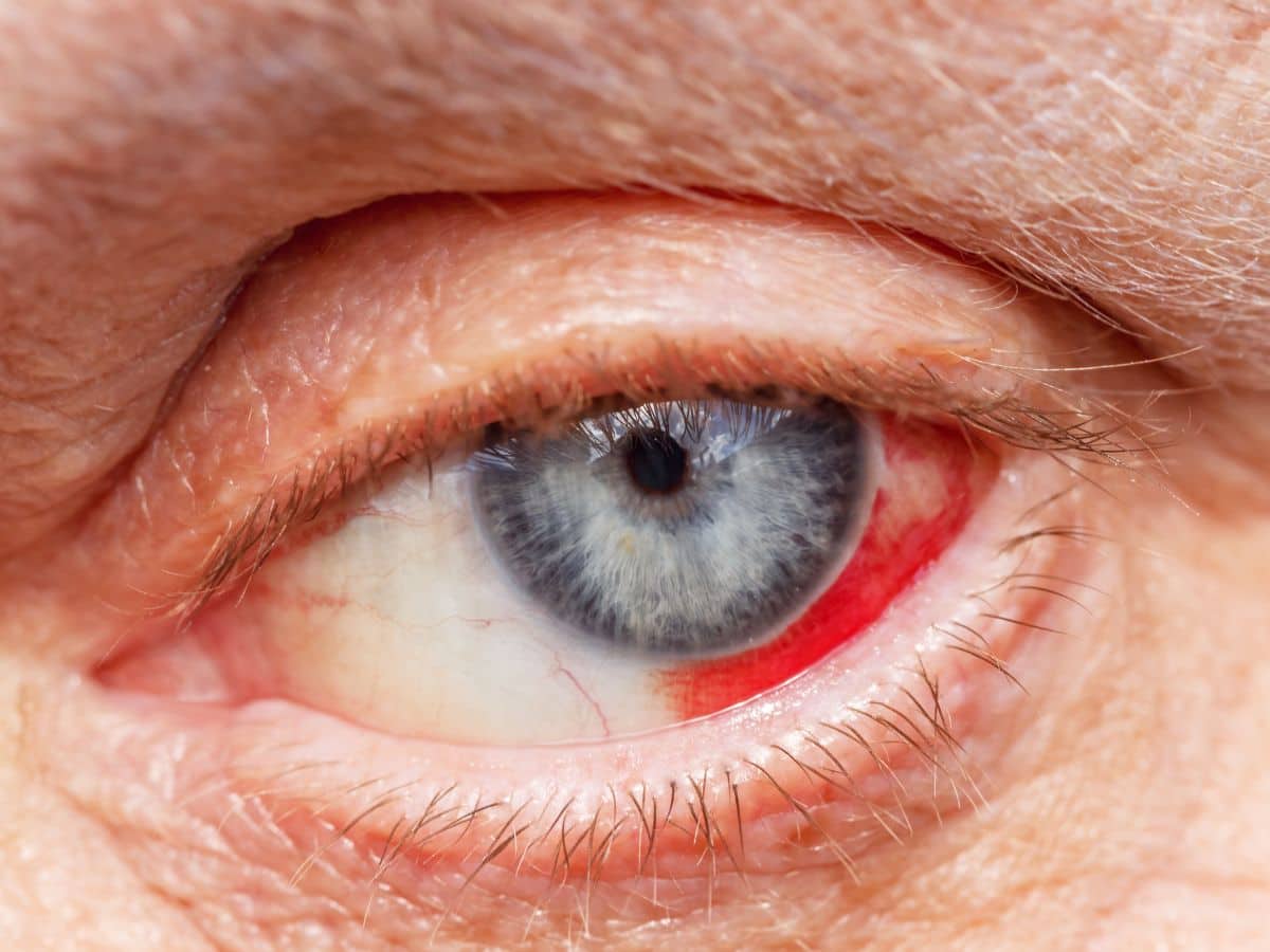 If You Notice This On Your Eyes, It Could Be A Sign Of High Cholesterol