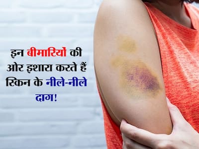 Skin par neele nishan padna | शरीर पर दिखने वाले नीले-नीले दाग को न