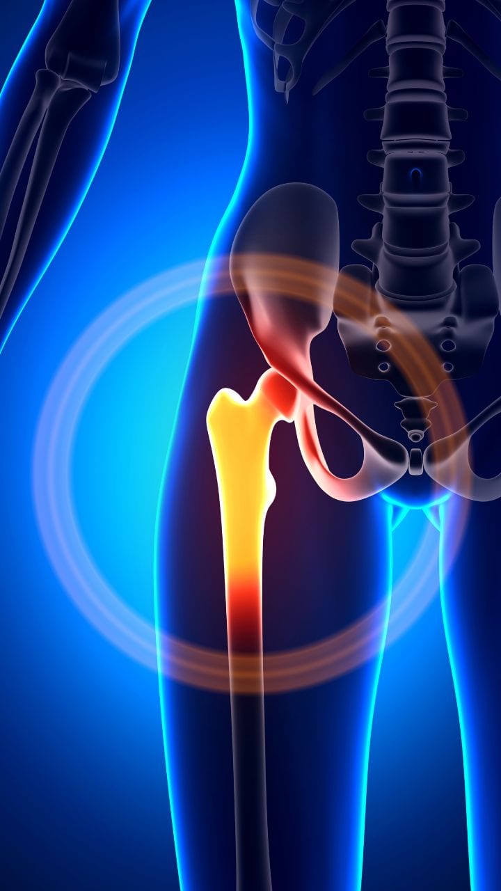 Bone Health: Know 5 Mistakes That Make Your Bone Weak - Vimarsana News