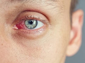 Eye Infection Symptoms: 5 Warning Signs You Should Never Ignore Eye Infection Symptoms: 5 Warning Signs You Should Never Ignore
