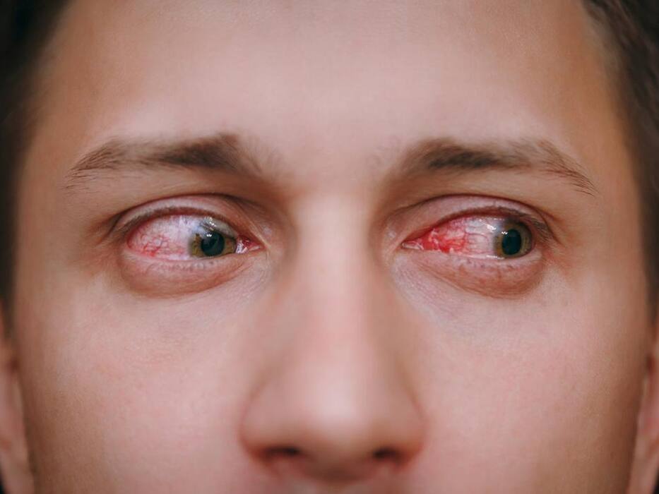 Eye Infection Symptoms: 5 Warning Signs You Should Never Ignore