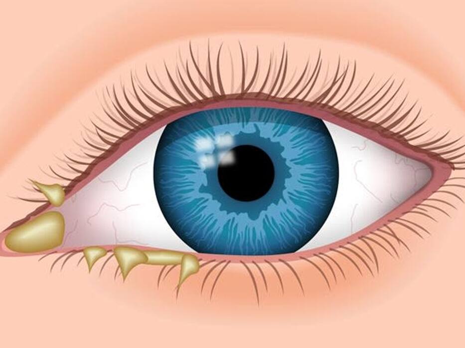 Eye Infection Symptoms: 5 Warning Signs You Should Never Ignore
