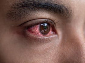Eye Infections In Monsoon: Cases Of Conjunctivitis Are On The Rise In Delhi Eye Infections In Monsoon: Cases Of Conjunctivitis Are On The Rise In Delhi