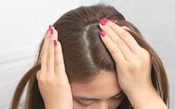 Home Remedies for Dandruff: अपनाए यह 6 घरेलू उपाय और अपने बालों के ड्रैंडफ को करे हमेशा के लिए बाय-बाय