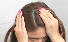 Home Remedies for Dandruff: अपनाए यह 6 घरेलू उपाय और अपने बालों के ड्रैंडफ को करे हमेशा के लिए बाय-बाय