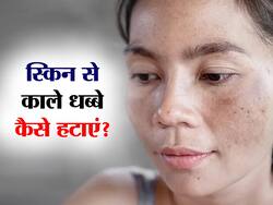 काले धब्बेदार दाग खूबसूरती में डाल सकते हैं खलल, इन नुस्खों से कुछ ही दिनों में पाएं छुटकारा