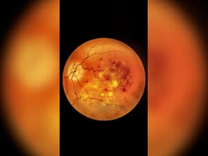 Diabetic Retinopathy: Causes, Symptoms And Treatments