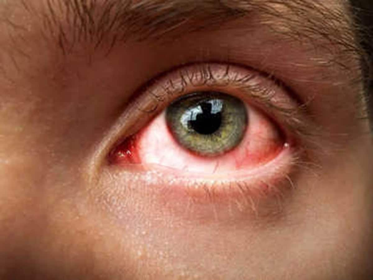 Conjunctivitis Cases On The Rise In Delhi: Symptoms, Causes And ...