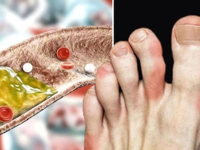 High Cholesterol Symptoms: 5 Warning Signs To Watch Out For In Your Fingers And Toes