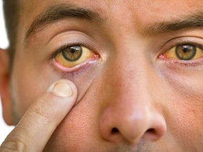 4 Alarming Indicators Of High Cholesterol In Your Eyes