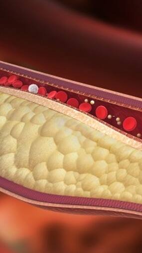 Risk Factor And Symptoms Of  Hypercholesterolemia