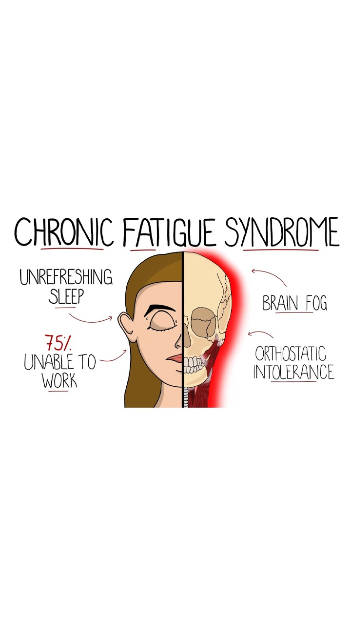 Chronic Fatigue Syndrome: Top 10 Symptoms Of CFS Disease