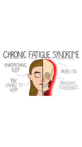 Chronic Fatigue Syndrome: Top 10 Symptoms Of CFS Disease